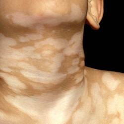 Example of pigmentation